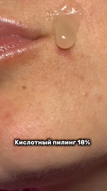 Кислотный пилинг против прыщей Cosmeya Art WB: #WW123362 #пилинг #уход #красота