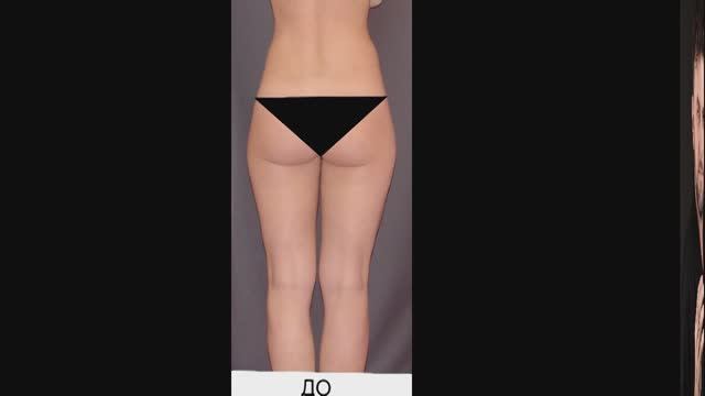 РУЧНАЯ ПЛАСТИКА ТЕЛА NEWBODYKA. КОРРЕКЦИЯ ФИГУРЫ.. РЕЗУЛЬТАТ ДО И ПОСЛЕ. ВИДЕО 1(1).