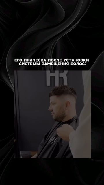 Мужская система волос до после