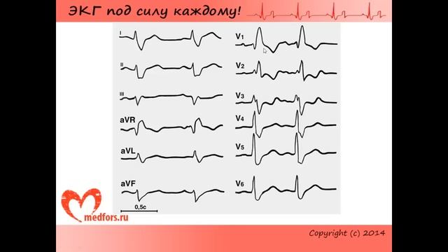 Урок 7. Видеокурс ЭКГ под силу каждому.