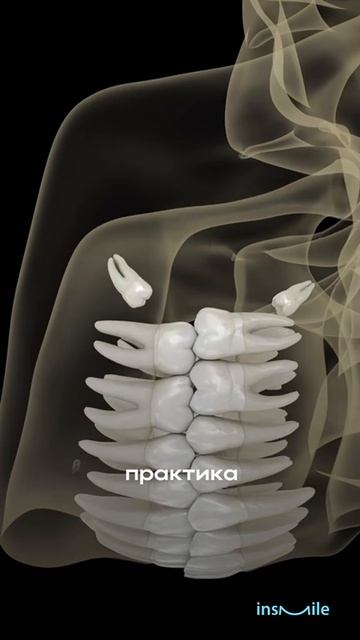 Нужно ли удалять зубы мудрости при ортодонтическом лечении?