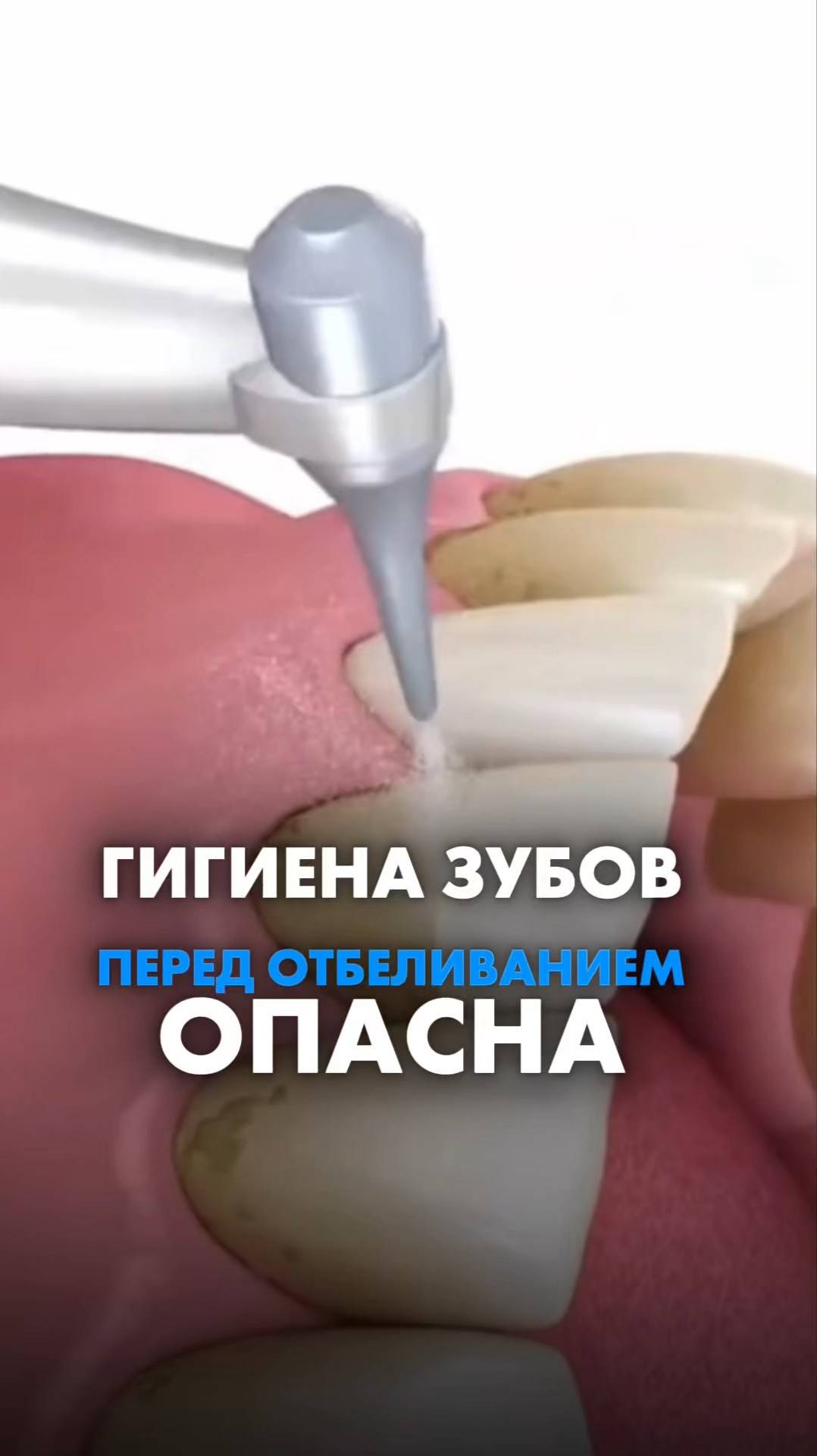 ГИГИЕНА ЗУБОВ ПЕРЕД ОТБЕЛИВАНИЕМ ОПАСНА? Татьяна Бондарева #ровныезуьы #капамиката