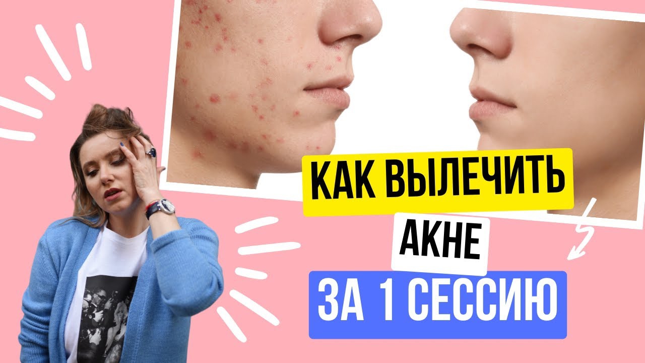 Быстрое избавление от акне. Запись прямого эфира. Техника в конце.