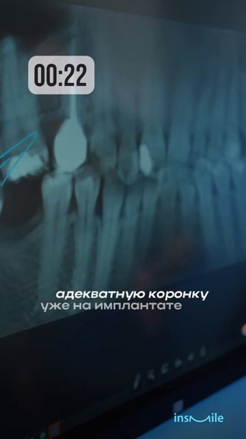 Выносим вердикт зубам мудрости за 1 минуту!