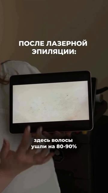 Лазерная эпиляция без боли и раздражения