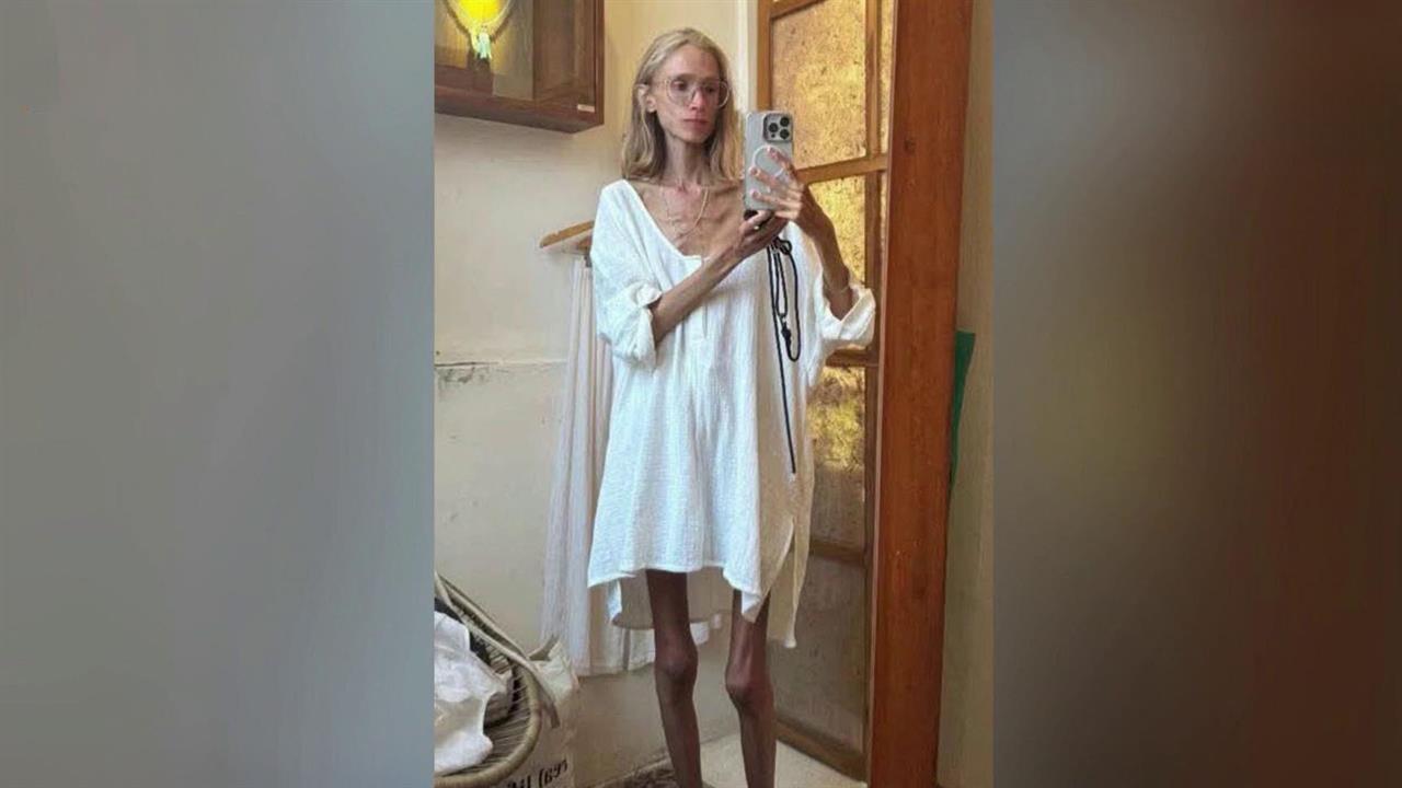 На Бали умерла от истощения 27-летняя поклонница сыроедения из Польши