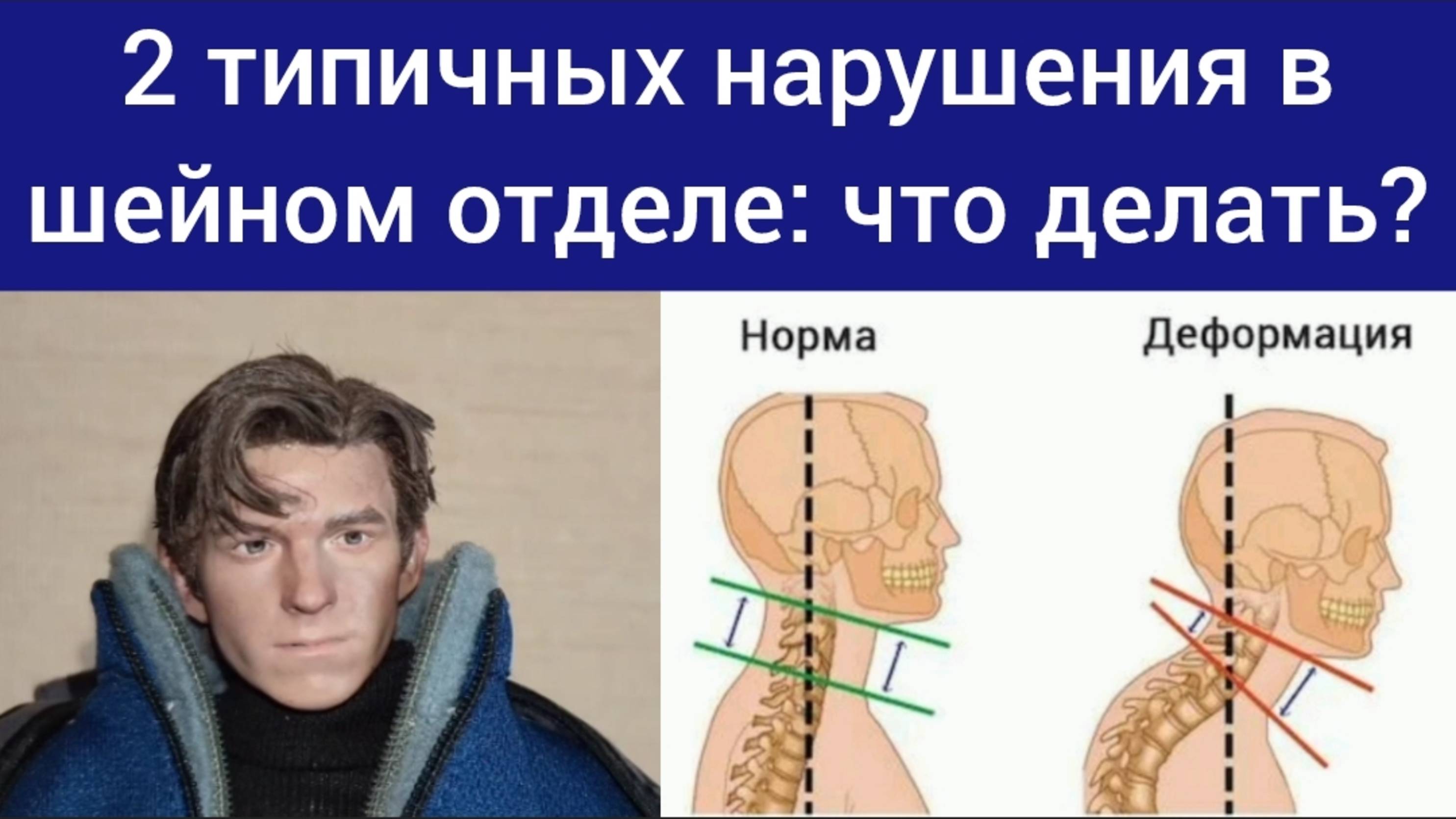 Шея: 2 типичных нарушения. Как освободить ключевые шейные нервы? Упражнения отзывы