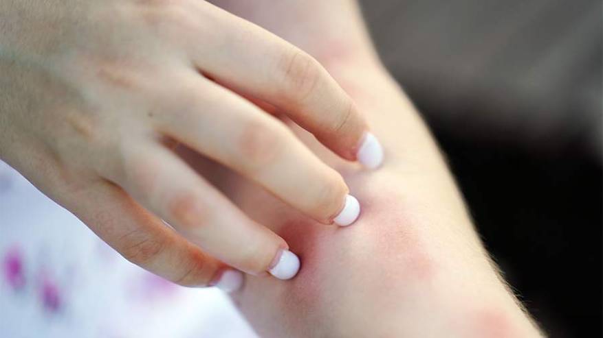 В России стремительно растет заболеваемость ветрянкой