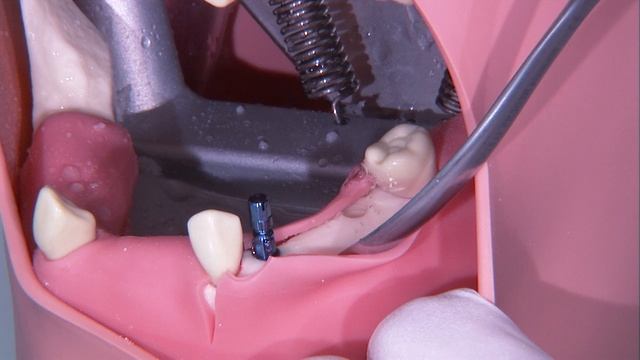 Упражнения на имплантах 19 часть промывание места имплантации