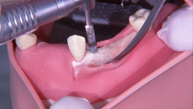 Упражнения на имплантах 11 часть корректировка