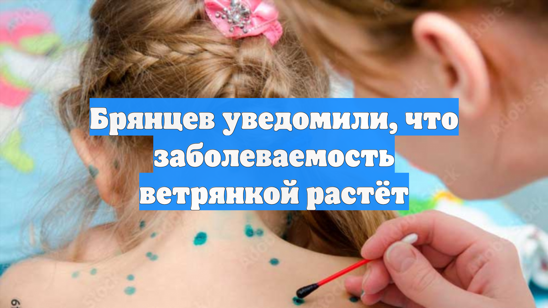 Брянцев уведомили, что заболеваемость ветрянкой растёт