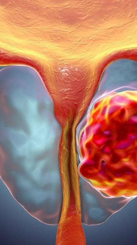 Рак простаты. 2 причины рака простаты. #shorts