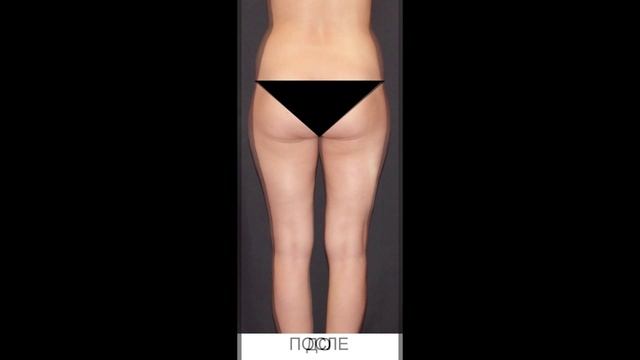 РУЧНАЯ ПЛАСТИКА ТЕЛА NEWBODYKA. КОРРЕКЦИЯ ФИГУРЫ. КАЛИНИН АЛЕКСЕЙ. РЕЗУЛЬТАТ ДО И ПОСЛЕ. ВИДЕО 2(1)