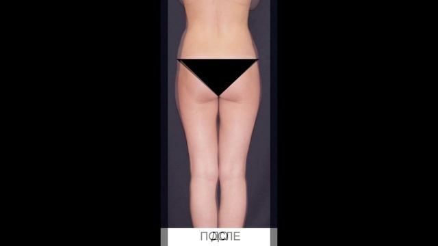 РУЧНАЯ ПЛАСТИКА ТЕЛА NEWBODYKA. КОРРЕКЦИЯ ФИГУРЫ. КАЛИНИН АЛЕКСЕЙ. РЕЗУЛЬТАТ ДО И ПОСЛЕ. ВИДЕО 3(1)