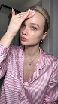 Прыщи на лице