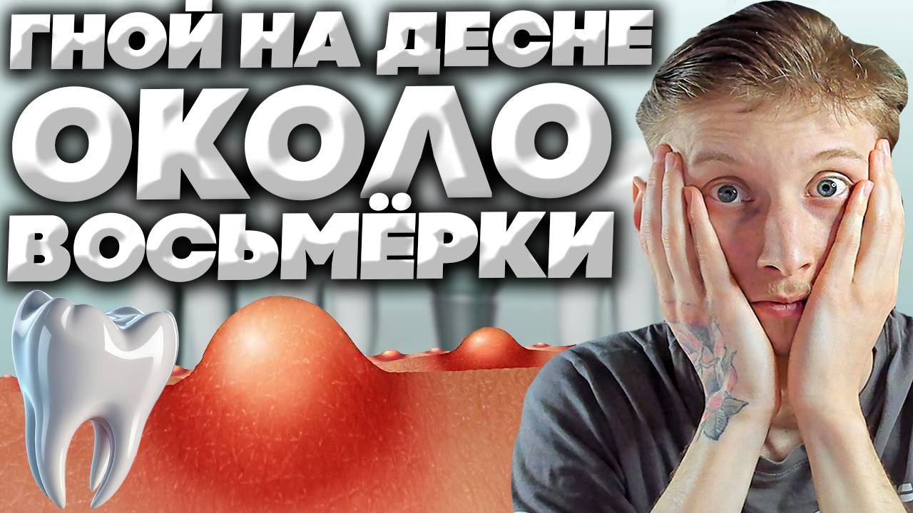 ГНОЙ СКОПИЛСЯ В ДЕСНЕ ОКОЛО ЗУБА МУДРОСТИ!УДАЛЕНИЕ ВОСЬМЁРКИ ЛЕЖАЧЕЙ!ДЕЛЮСЬ ОПЫТОМ ОПЕРАЦИИ!