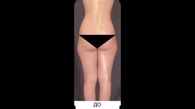 РУЧНАЯ ПЛАСТИКА ТЕЛА NEWBODYKA. КОРРЕКЦИЯ ФИГУРЫ. КАЛИНИН АЛЕКСЕЙ. РЕЗУЛЬТАТ ДО И ПОСЛЕ. ВИДЕО 4(1)