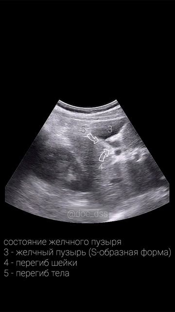 УЗИ желчного пузыря #врач #медицина #рекомендации #узи #анатомия #физиология #знания #образование
Не