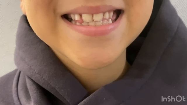 Артикуляционная гимнастика как основа правильного звукопроизношения