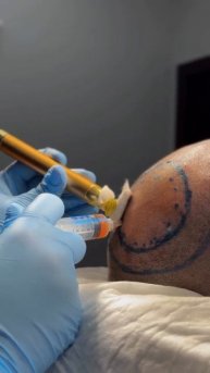 📌 Дано- андрогенная алопеция 2-3 степени Решение- провели ювелирную работу и успешно пересадили