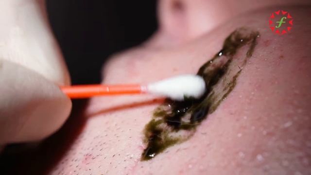 Косметология. Применение фотодинамической терапии с препаратом "Фотодитазин"