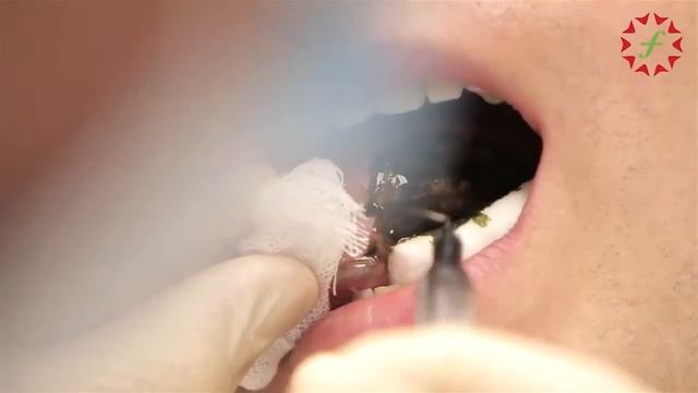 Профессор И.М. Рабинович  о  ФДТ с "Фотодитазином" в стоматологии