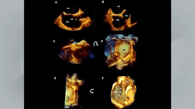 Guidelines for the Echocardiographic Assessment of Atrial Septal Defect & Patent Foramen Ovale