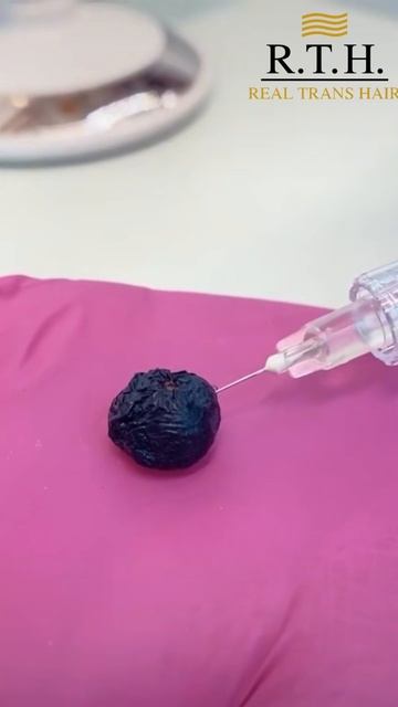 Radiesse — волшебный препарат?