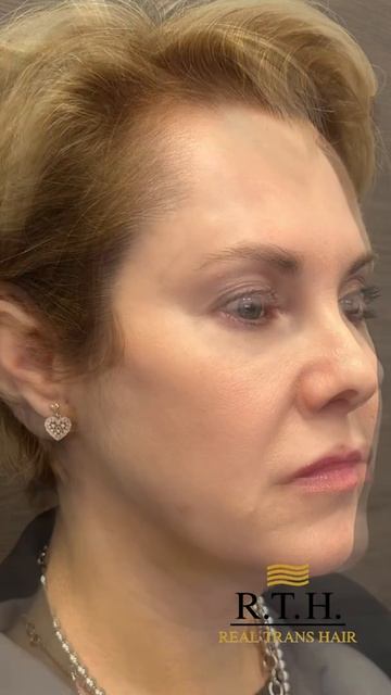 Платизмопластика: наглядное восстановление с первого дня.