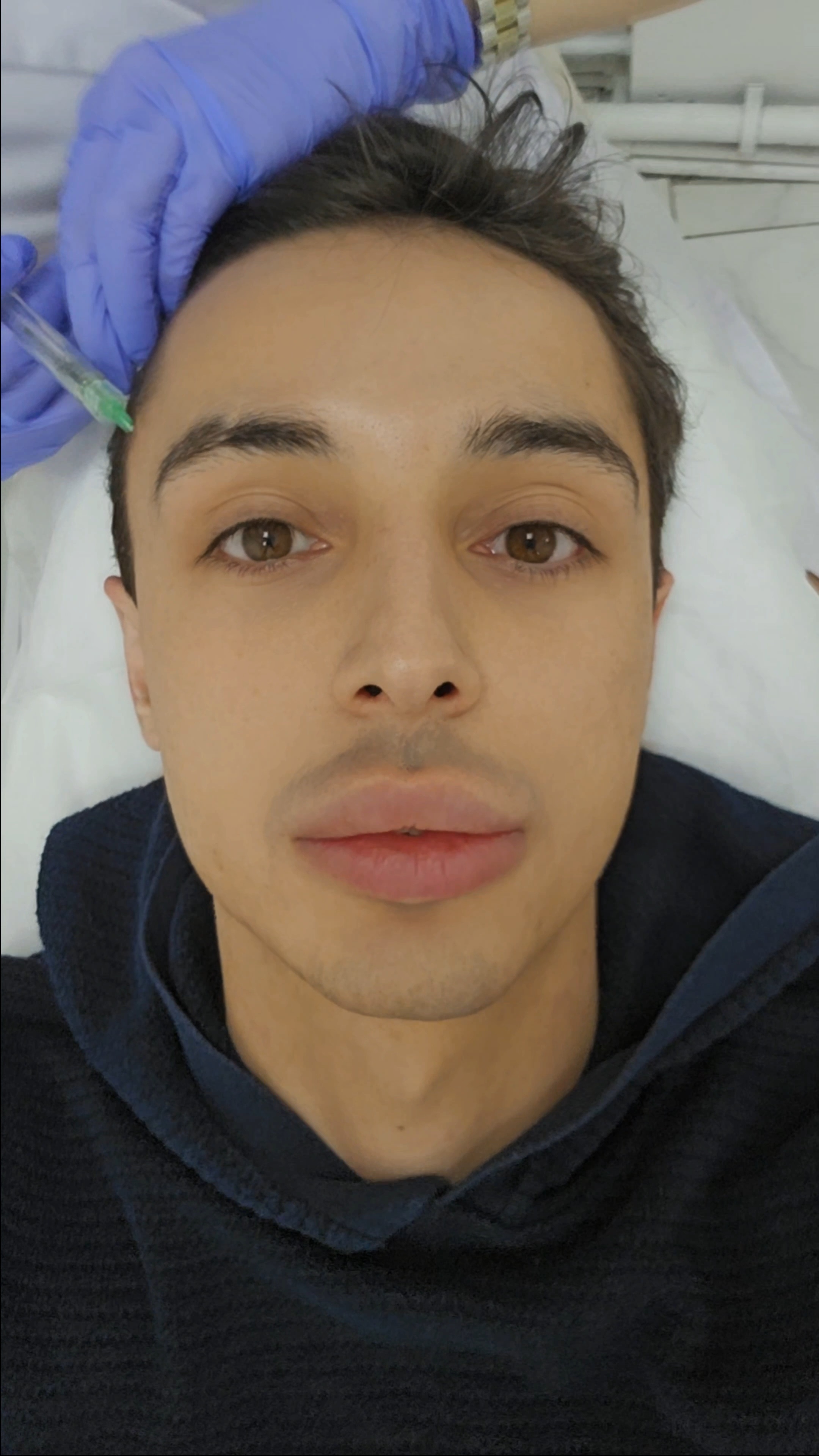 Пептидная мезотерапия волос