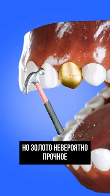 Кратко о плюсах и минусах золотых зубов