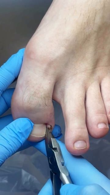 Удаление вросшего ногтя. Подологический центр Адонис. Нальчик, Лермонтова, 30. 89626528507