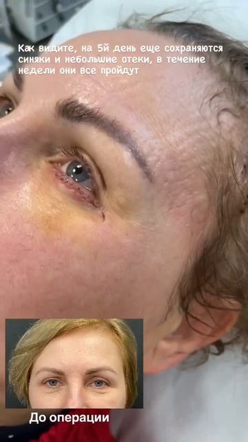 5 дней после нижней блефаропластики с меопексией и височного лифтинга!