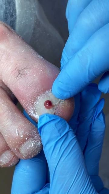 Исправляем последствия неправильного протезирования в центре Адонис. Нальчик, Лермонтова, 30