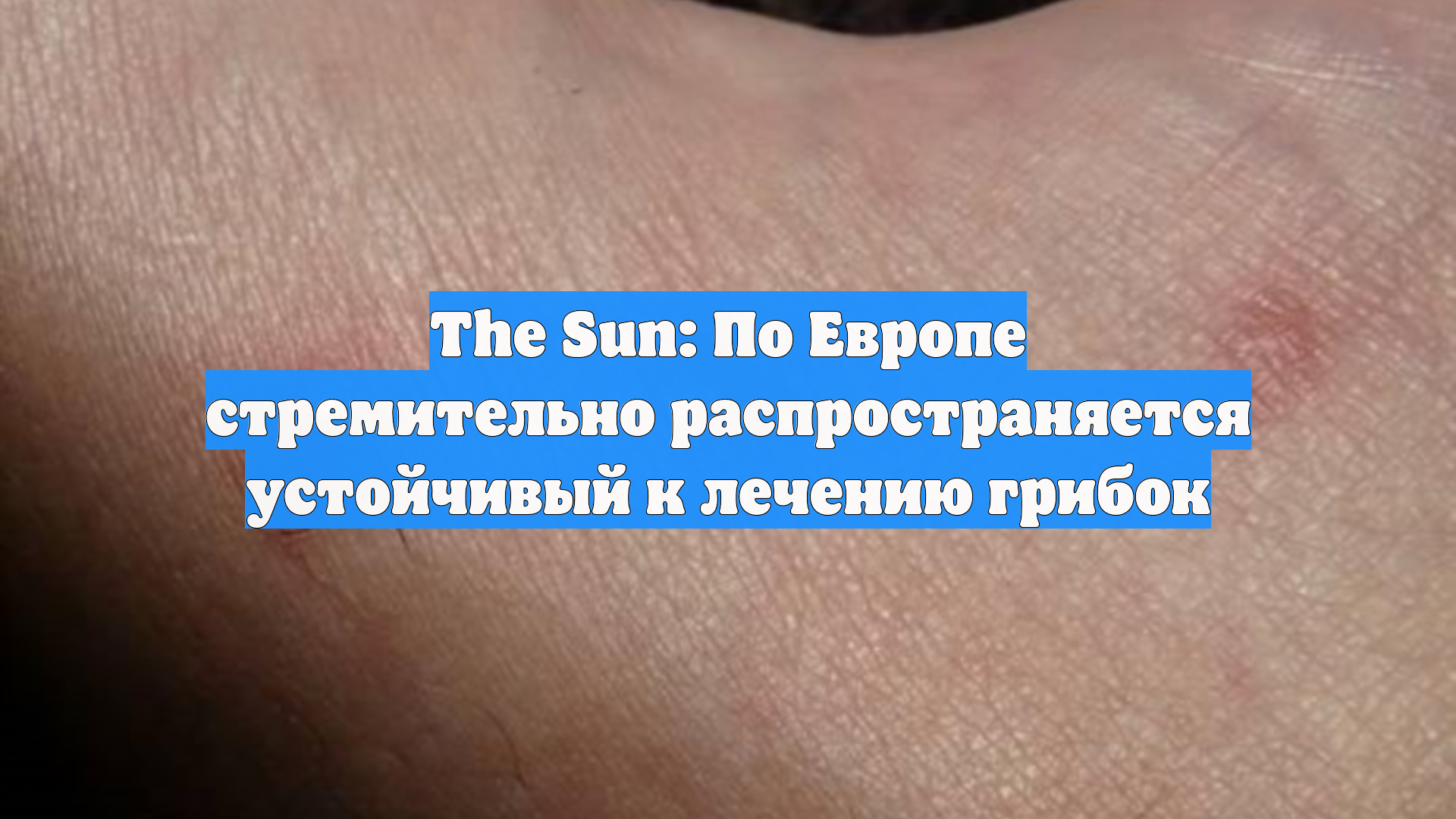 The Sun: По Европе стремительно распространяется устойчивый к лечению грибок