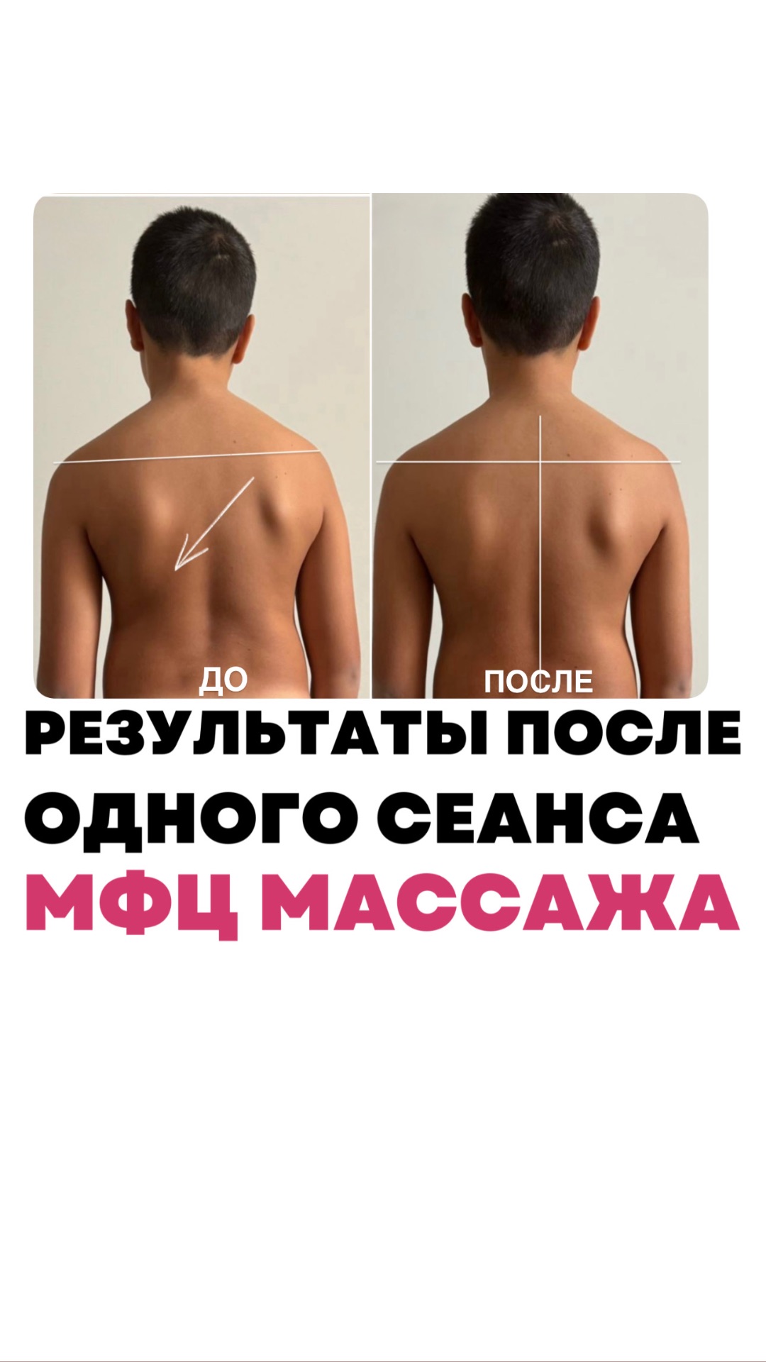 Миофасциальный массаж результаты