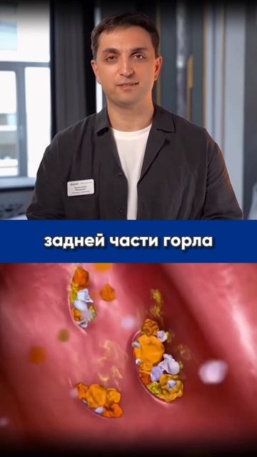 Камни в гландах