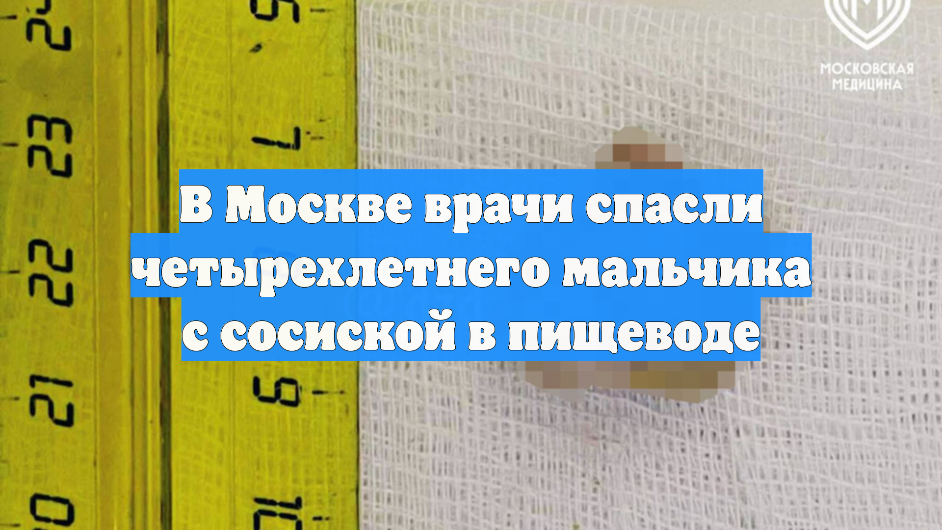 Московские врачи спасли четырехлетнего мальчика с сосиской в пищеводе
