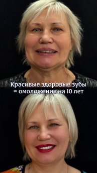 До и после пациента