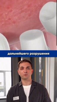 Для чего необходима зубная коронка?