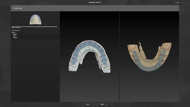 Рабочий процесс 7 - Создание хирургических шин _ IPS CaseDesigner® Руководство