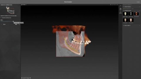 Дополнительный рабочий процесс – Аннотация нижнечелюстного нерва _ IPS CaseDesigner® Руководство
