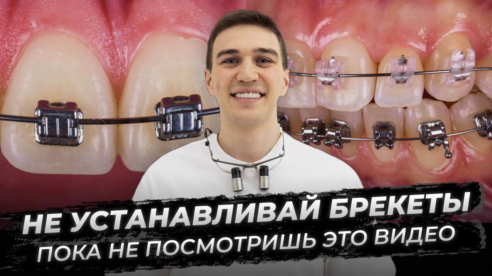 Не устанавливайте брекеты