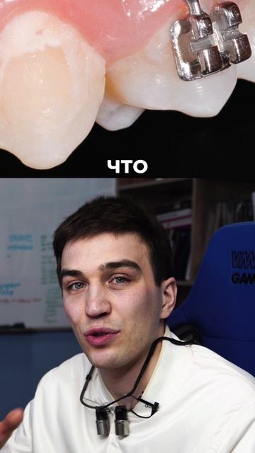 Зубы после брекетов