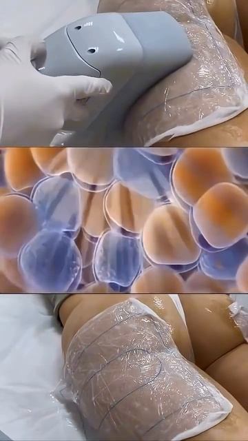 Убираем за 1 сеанс до 20-70% подкожного жира #похудение #похудетьбыстро #питание #криолиполиз