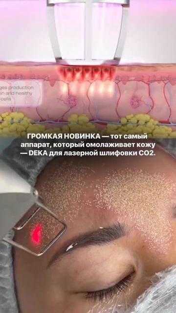 Громкая НОВИНКА для лазерной шлифовки кожи!