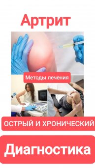ОСТРЫЙ И ХРОНИЧЕСКИЙ АРТРИТ. Методы лечения