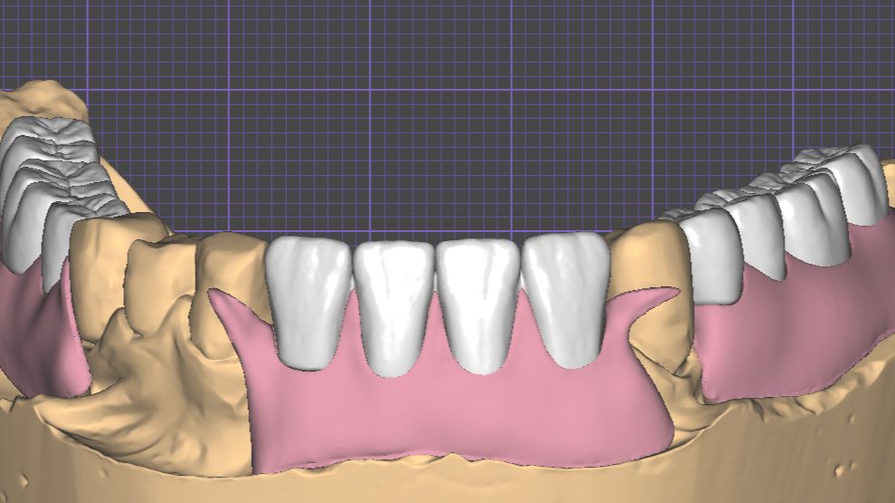 Моделирование частично съемного протеза в ExoCad + совет по его печати