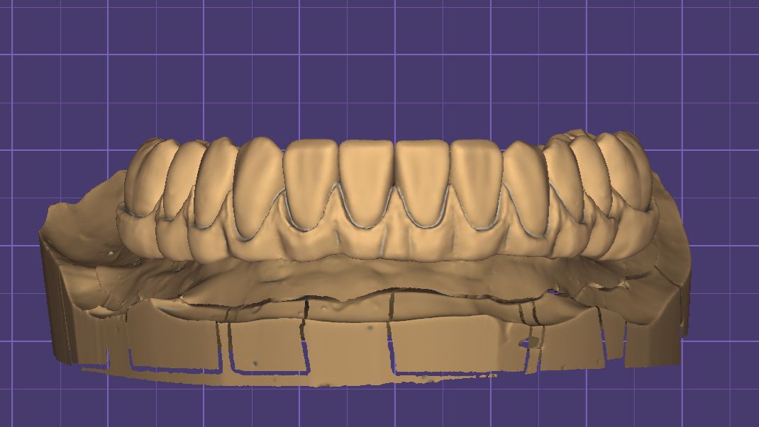 Моделирование искусственной десны для FP3 в Exocad.