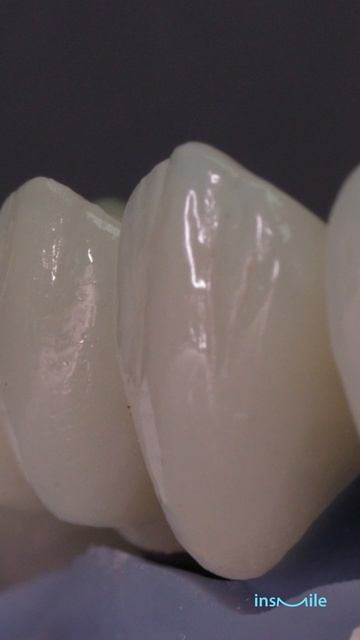 Veneers - идеальная улыбка в мельчайших деталях! Запись на приём по ссылке в шапке профиля